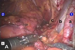 Robot-assisted Laparoscopic Radical Cystectomy with Ileal Conduit Urinary Diversion